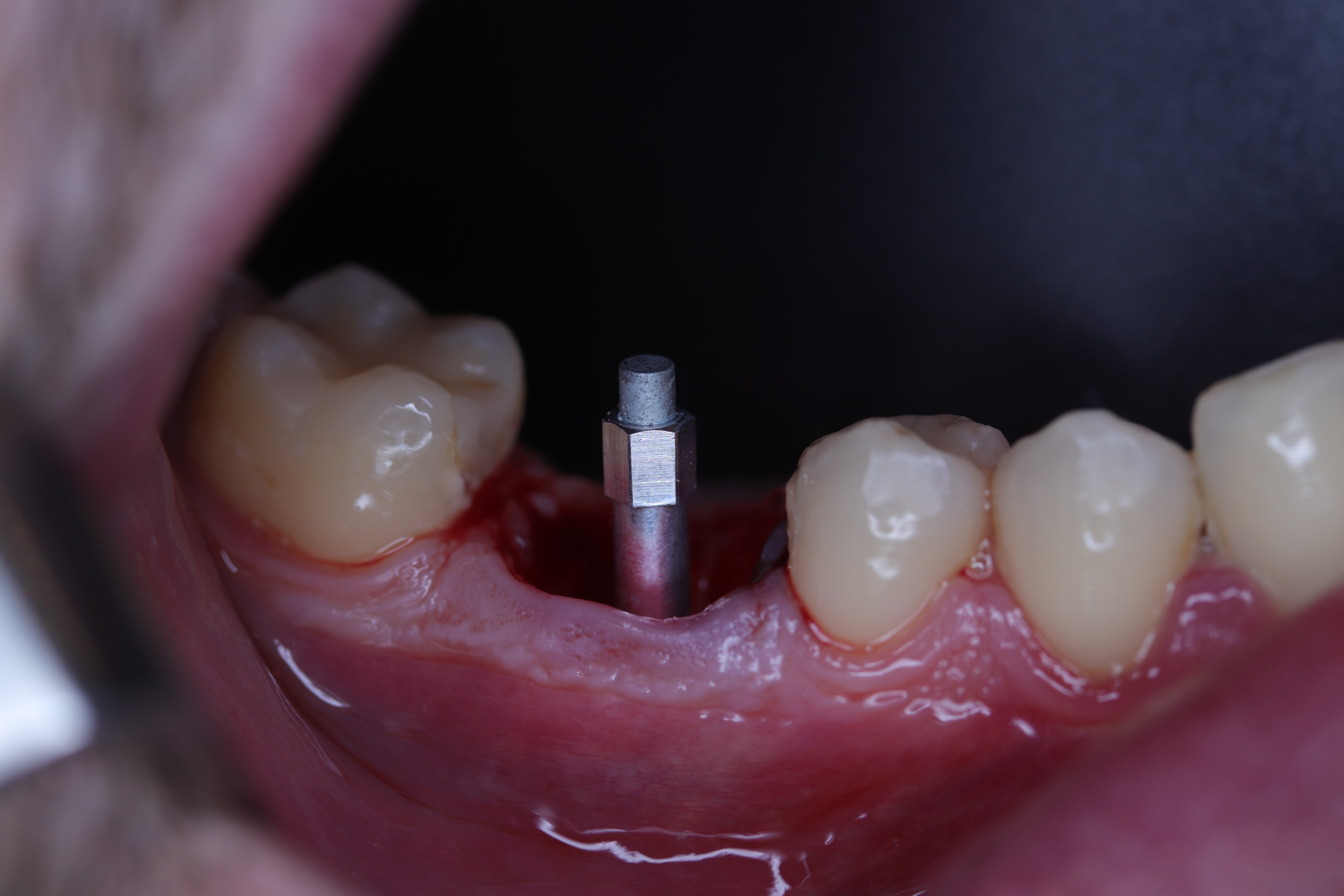 Essential in Oral Implantology The ISQ value by Dr Emilio Rodríguez